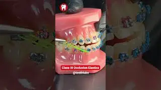 Class III Occlusion Elastics #shorts