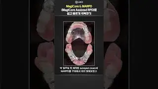 [Case Review 61st] 무치악 케이스, MagiCore & MARPD(MagiCore Assisted RPD)로 쉽고 빠르게 극복하기