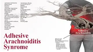 Adhesive Arachnoiditis Syndrome - Is it a syndrome?