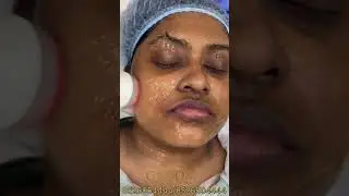 Hydra facial