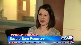 Burn Center helps couple recover