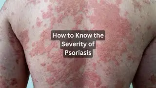 How to Calculate Psoriasis Severity at Home | Psoriasis Severity Index