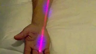 Cold Laser Easing Carpal Tunnel Pain
