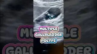 Multiple Gallbladder Polyps Ultrasound #gallbladder #gallbladderultrasound #gallbladderpolyps