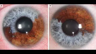 Iris Heterochromie