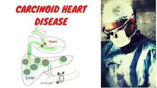 Carcinoid Heart Disease; Symptoms, Diagnosis and Treatment