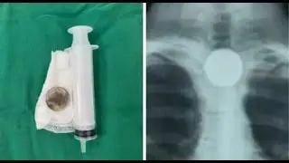 Niño se atragantó con una moneda y fue trasladado de urgencia a Asunción