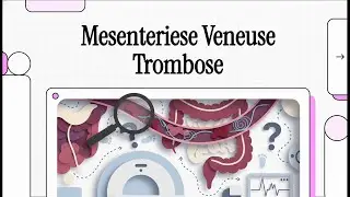137 Mesenteriese Veneuse Trombose