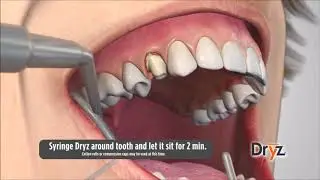 Dryz&reg; Hemostatic Retraction Paste by Parkell Inc
