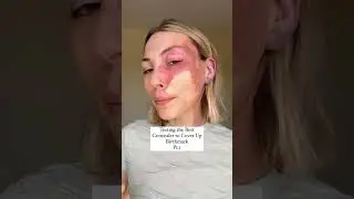 Testing Concealers on Birthmark pt.1