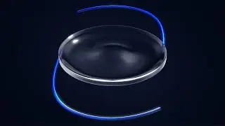 RxSight&trade; Light Adjustable Lens (LAL) Overview | Feinerman Vision