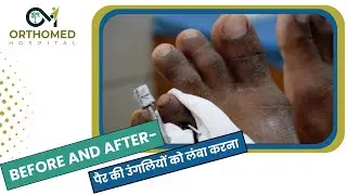 डॉ. संजय अरोड़ा द्वारा पैर की उंगलियों को लंबा करने की सर्जरी | हिसार में सबसे अच्छा अस्पताल I