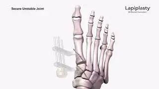 Dr. Paul Discusses Lapiplasty 3D Bunion Correction at FACI