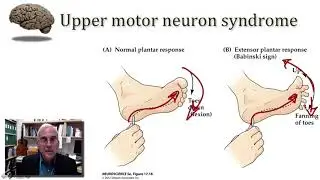 UMNC Upper Motor Neuron Syndrome