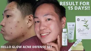 E2 ▪  HELLO GLOW  ACNE DEFENSE SET HONEST REVIEW IN TWO WEEKS