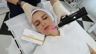 DERMAQUAL FORZA MMS 007 MESOGLOW FACELIFT MESOTHERAPY