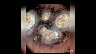 Shortcase:Reactive perforating collagenosis