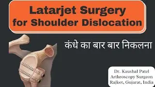 How to treat Shoulder Dislocation? Latarjet Surgery for Shoulder dislocation  #shoulderdislocation