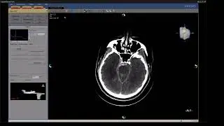Case-1,  Basilar and  MCA Aneurysm  embolization , 27-01-2026