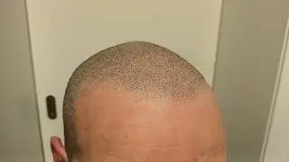 Nooit meer kaal met Micro haar pigmentatie stoppeltattoo tegen kaalheid mhp