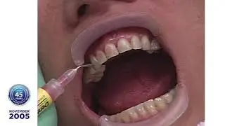Dr. Robert Ibsen Presents Bev S., a Lumineers&reg; Clinical Case Presentation: 2005
