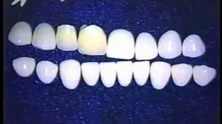 Porcelain Crowns - Long Island Dentist