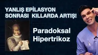 Yanlış Epilasyon Kılları Artırıyor! 🚨 Paradoksal Hipertrikoz Nedir?  ve Uzman Tavsiyeleri