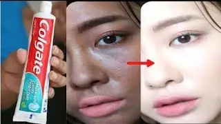 Toothpaste mask for skin whitening! Whitening dark spots!