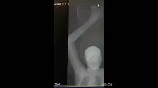 Upper Limb Angiography/ How to Perform Angio on 16 Slice Machine / Toshiba, Canon 