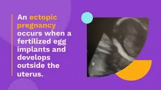 Ectopic pregnancy #pregnancy #ultrasound #sonographer #health #anatomy