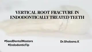 Seed Dental Masters - Endodontic Tip -Vertical Root fracture in RCT Teeth