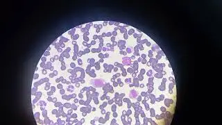 Leuc&eacute;mie ( Promy&eacute;locytes, My&eacute;locytes, M&eacute;tamy&eacute;locytes, Promonocytes et les blastes ). سرطان الدم