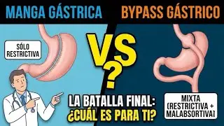 Which surgery is better? Sleeve gastrectomy or bypass?