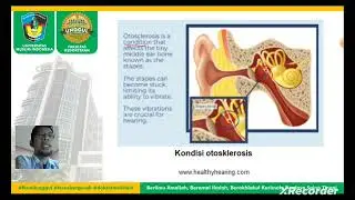 Mengenal Otosklerosis, gangguan pendengaran akibat kekakuan tulang pendengaran, tulang stapes.