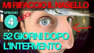 RINOSETTOPLASTICA - CON TITO MARIANETTI - EPISODIO 4 - DUE MESI DOPO L'INTERVENTO!