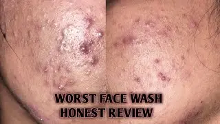 Is Face Wash Ne Meri MRI Skin Ka Kya Hal Kr Dya | Acne Skin Waly Pehle Ye Video Dekhein |  Jenpharm 
