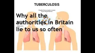 Tuberculosis in Coventry, why the British authorities seem incapable of telling us the truth