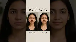 Advanced Hydrafacial: 4 Steps to Perfect, Glowing Skin ! Skin And Soul Aesthetics | #skincare