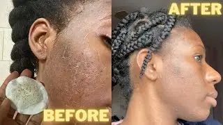 PCA SKIN CHEMICAL PEEL FULL EXPERIENCE | BEFORE & AFTER | * raw *