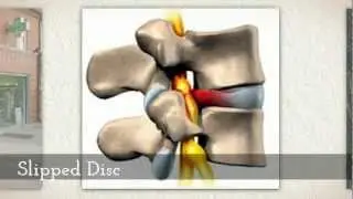 Slipped Disc-Limerick Pain Relief and Sports Injury Clinic