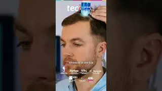 Androgenetic Alopecia: Diagnosis and Clinical Treatment ❘ TECH Global University