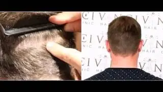 Les Techniques de Greffe Capillaire FUT et FUE Laquelle est la meilleure ? - Vinci Hair Clinic