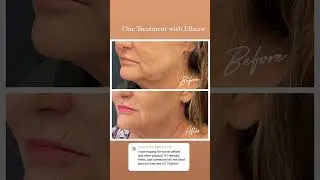 Non-surgical face lift #ellacor