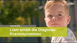 Der kleine Liam und seine Diagnose «Kraniosynostose»