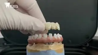 Barra del ponte in zirconio;corone in zirconia su culti in zirconia.