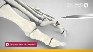 Jak przebiega operacja korekcji palca młotkowatego?