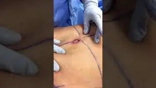The Magnificent Journey of the Belly Button During a Tummy Tuck! #shorts