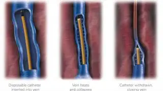 Complications of Vein Stripping and Ligation