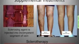Rocky Mountain Vein Clinic Online Webinar - 05/11/2010