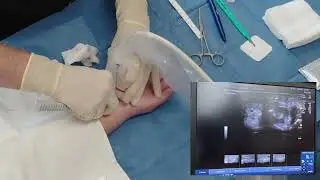 Minimally Invasive Carpal Tunnel Release Under Local Anesthesia - In Office Surgery